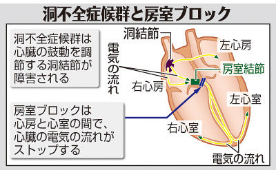 （下）　洞不全症候群と房室ブロック