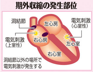 （上）　期外収縮の発生部位