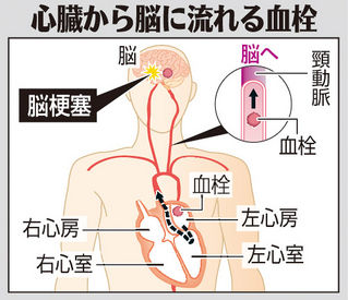 （中）　心臓から脳に流れる血栓