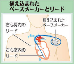 （下）　ペースメーカーとリード