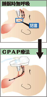 （下）　CPAP療法