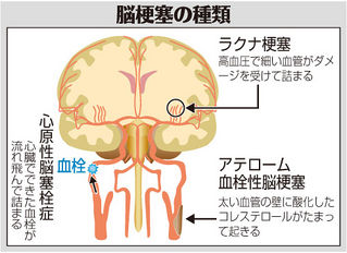 （上）　脳梗塞の種類