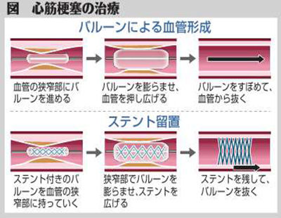 （中）図　心筋梗塞の治療