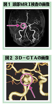 （下）図１　頭部MRI検査画像