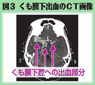 （上）図３　くも膜下出血のCT画像