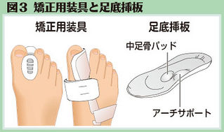 （上）図3　矯正用装具と足底挿板