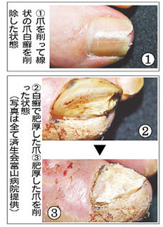 爪白癬の治療