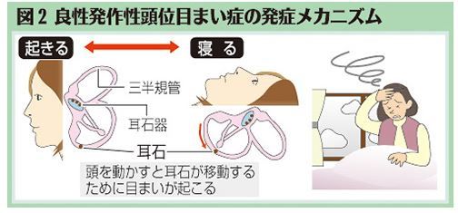 （上）図2　良性発作性頭位めまい症発症メカニズム