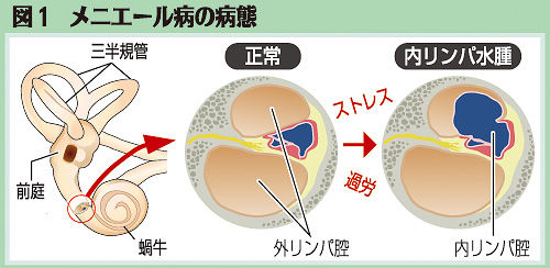 メニエール図1